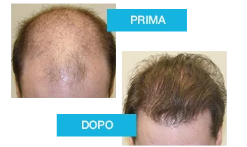 Crescita e densità dei capelli con Profolan